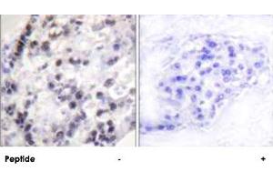 Immunohistochemistry analysis of paraffin-embedded human breast carcinoma tissue using HNRNPC polyclonal antibody . (HNRNPC antibody  (Ser260))
