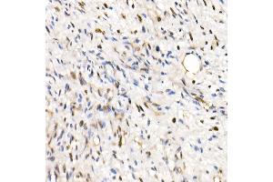 Immunohistochemistry of paraffin-embedded Human epithelioid sarcoma (ini-1 deletion) using SM/SNF5 Rabbit pAb  at dilution of 1:250 (40x lens). (SMARCB1 antibody  (AA 77-376))
