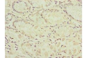 Immunohistochemistry of paraffin-embedded human gastric cancer using ABIN7164324 at dilution of 1:100 (RARS2 antibody  (AA 17-340))