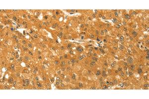 Immunohistochemistry of paraffin-embedded Human liver cancer using TM7SF2 Polyclonal Antibody at dilution of 1:30 (TM7SF2 antibody)