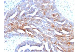 Formalin-fixed, paraffin-embedded human Ovarian Carcinoma stained with TAG-72 Mouse Monoclonal Antibody (B72. (TAG-72 / CA72.4 antibody)