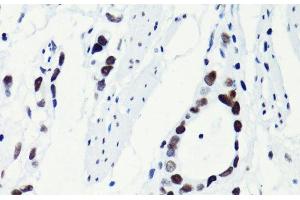 Immunohistochemistry of paraffin-embedded Human gastric cancer using Acetyl-Histone H2B-K5 Polyclonal Antibody at dilution of 1:100 (40x lens). (Histone H2B antibody  (acLys5))