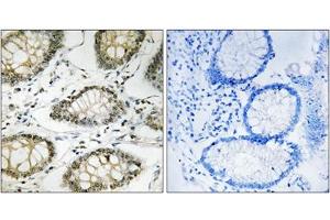 Immunohistochemical staining of paraffin-embedded human colon carcinoma tissue reacted with ATR (phospho S428) polyclonal antibody  at 1:50-1:100 dilution. (ATR antibody  (pSer428))