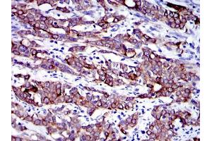 Immunohistochemical analysis of paraffin-embedded human cervical cancer tissues using KRT19 mouse mAb with DAB staining. (Cytokeratin 19 antibody)