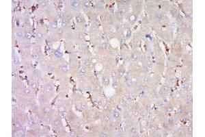 Paraformaldehyde-fixed, paraffin embedded human liver carcinoma, Antigen retrieval by boiling in sodium citrate buffer (pH6) for 15min, Block endogenous peroxidase by 3% hydrogen peroxide for 30 minutes, Blocking buffer (normal goat serum) at 37°C for 20min, Antibody incubation withRabbit Anti-BSEP Polyclonal Antibody, Unconjugated  at 1:500 overnight at 4°C, followed by a conjugated secondary for 90 minutes and DAB staining. (ABCB11 antibody  (AA 21-120))