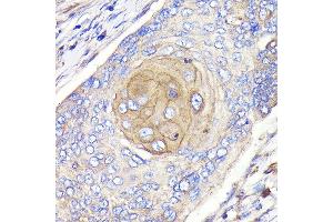 Immunohistochemistry of paraffin-embedded human esophageal cancer using FGFR3 Rabbit mAb (ABIN7267191) at dilution of 1:100 (40x lens). (FGFR3 antibody)