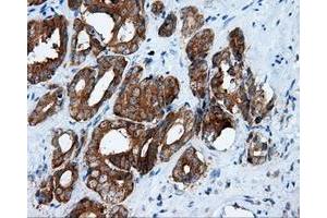 Immunohistochemical staining of paraffin-embedded Adenocarcinoma of ovary tissue using anti-RALBP1 mouse monoclonal antibody. (RALBP1 antibody)