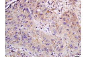 Formalin-fixed and paraffin embedded human laryngocarcinoma labeled with Anti-CYB5R4 Polyclonal Antibody, Unconjugated  at 1:200 followed by conjugation to the secondary antibody and DAB staining. (CYB5R4 antibody  (AA 21-120))