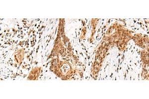 Immunohistochemistry of paraffin-embedded Human esophagus cancer tissue using DGCR6L Polyclonal Antibody at dilution of 1:65(x200)