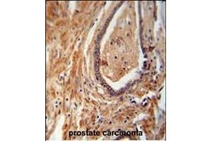 NDUFAF1 antibody (C-term) (ABIN654702 and ABIN2844394) immunohistochemistry analysis in formalin fixed and paraffin embedded human prostate carcinoma followed by peroxidase conjugation of the secondary antibody and DAB staining. (NDUFAF1 antibody  (C-Term))