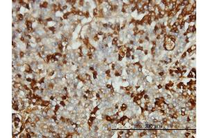 Immunoperoxidase of monoclonal antibody to FGG on formalin-fixed paraffin-embedded human hepatocellular carcinoma tissue. (FGG antibody  (AA 31-130))