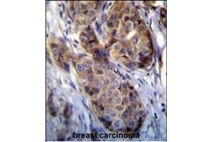 GEA12 antibody (N-term) (ABIN390104 and ABIN2840616) immunohistochemistry analysis in forlin fixed and paraffin embedded hun breast carcino followed by peroxidase conjugation of the secondary antibody and DAB staining. (MAGEA12 antibody  (N-Term))