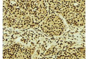 ABIN6274755 at 1/100 staining Human breast cancer tissue by IHC-P. (RPS3 antibody  (Internal Region))