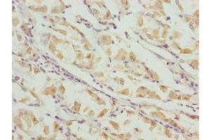 Immunohistochemistry of paraffin-embedded human gastric cancer using ABIN7156409 at dilution of 1:100 (Integrator Complex Subunit 14 (INTS14) (AA 231-518) antibody)