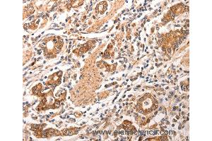 Immunohistochemistry of Human gastric cancer using CCL17 Polyclonal Antibody at dilution of 1:70