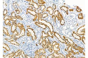 ABIN6258560 and ABIN6275594 at 1/100 staining Human kidney cancer and adjacent normal tissues by IHC-P.