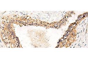 Immunohistochemistry of paraffin-embedded Human breast cancer tissue using GPR152 Polyclonal Antibody at dilution of 1:55(x200) (GPR152 antibody)