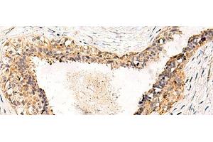 Immunohistochemistry of paraffin-embedded Human breast cancer tissue using GPR152 Polyclonal Antibody at dilution of 1:55(x200) (GPR152 antibody)