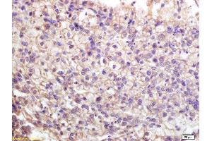 Formalin-fixed and paraffin embedded human lung carcinoma labeled with Anti-Phospho-ATP1A1(Ser16) Polyclonal Antibody, Unconjugated  at 1:200 followed by conjugation to the secondary antibody and DAB staining. (ATP1A1 antibody  (pSer16))