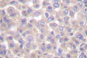 Immunohistochemical analysis of paraffin-embedded human breast cancer tissue using TRADD polyclonal antibody .