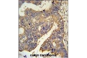 R6G Antibody (N-term) (ABIN650946 and ABIN2840004) IHC analysis in formalin fixed and raffin embedded human colon carcinoma followed by peroxidase conjugation of the secondary antibody and DAB staining.
