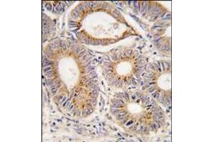 Formalin-fixed and paraffin-embedded human colon carcinoma tissue reacted with FGF1 antibody (N-term), which was peroxidase-conjugated to the secondary antibody, followed by DAB staining. (FGF1 antibody  (N-Term))