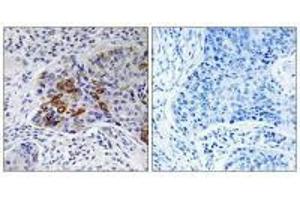 Immunohistochemistry analysis of paraffin-embedded human lung carcinoma tissue, using ADCY9 antibody. (ADCY9 antibody  (N-Term))