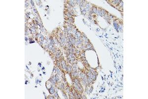 Immunohistochemistry of paraffin-embedded human colon carcinoma using L1 Rabbit pAb (ABIN6134555, ABIN6137248, ABIN6137250 and ABIN6215529) at dilution of 1:100 (40x lens). (ATG16L1 antibody  (AA 200-300))