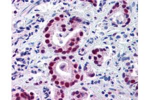 Anti-HDAC1 antibody IHC of human prostate carcinoma. (HDAC1 antibody  (AA 466-482))