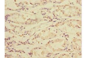 Immunohistochemistry of paraffin-embedded human gastric cancer using ABIN7172004 at dilution of 1:100 (TXNDC5 antibody  (AA 1-324))