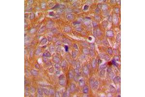 Immunohistochemical analysis of CARD14 staining in human breast cancer formalin fixed paraffin embedded tissue section. (CARD14 antibody  (Center))