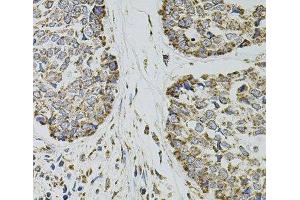 Immunohistochemistry of paraffin-embedded Human esophageal cancer using SELP Polyclonal Antibody at dilution of 1:100 (40x lens). (P-Selectin antibody)