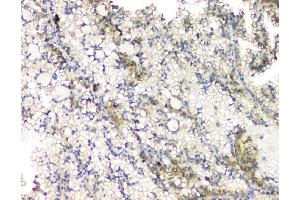 IHC analysis of RHOB using anti-RHOB antibody (ABIN6719538). (RHOB antibody)