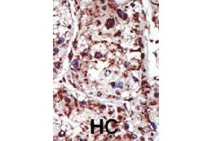 Formalin-fixed and paraffin-embedded human hepatocellular carcinoma tissue reacted with PACSIN1 polyclonal antibody  , which was peroxidase-conjugated to the secondary antibody, followed by DAB staining. (PACSIN1 antibody  (Internal Region))