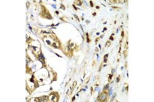 Immunohistochemistry of paraffin-embedded human liver cancer using TMOD4 antibody at dilution of 1:100 (x40 lens). (Tropomodulin 4 antibody)
