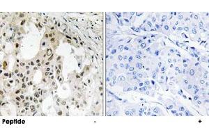 Immunohistochemistry analysis of paraffin-embedded human breast carcinoma tissue using EIF3D polyclonal antibody . (EIF3D antibody)