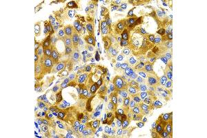 Immunohistochemistry of paraffin-embedded human liver cancer using CDK20 antibody. (CCRK antibody)