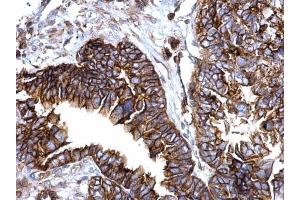 IHC-P Image IFITM1 antibody detects IFITM1 protein at cytosol and membrane on human ovarian carcinoma by immunohistochemical analysis. (IFITM1 antibody)