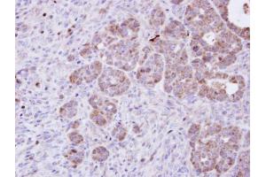 IHC-P Image Immunohistochemical analysis of paraffin-embedded NCIN87 xenograft, using Amphiphysin, antibody at 1:100 dilution. (Amphiphysin antibody  (N-Term))