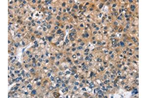 The image on the left is immunohistochemistry of paraffin-embedded Human liver cancer tissue using ABIN7128679(BPI Antibody) at dilution 1/50, on the right is treated with fusion protein.