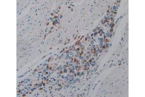 IHC-P analysis of Human Stomach Cancer Tissue, with DAB staining. (PTPRQ antibody  (AA 36-294))