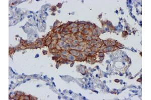 Immunohistochemical staining of paraffin-embedded Carcinoma of Human lung tissue using anti-CD80 mouse monoclonal antibody. (CD80 antibody)