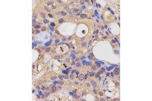 (ABIN6243855 and ABIN6577442) staining RK7 in human breast carcinoma sections by Immunohistochemistry (IHC-P - raformaldehyde-fixed, raffin-embedded sections). (PARK7/DJ1 antibody  (C-Term))