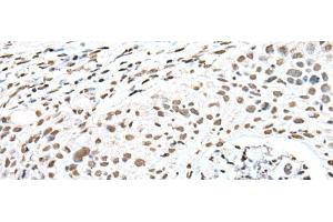 Immunohistochemistry of paraffin-embedded Human lung cancer tissue using SNRPA Polyclonal Antibody at dilution of 1:30(x200) (SNRPA1 antibody)