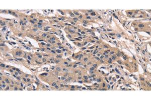 Immunohistochemistry of paraffin-embedded Human lung cancer using PEBP1 Polyclonal Antibody at dilution of 1:40 (PEBP1 antibody)