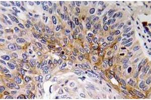 Immunohistochemistry (IHC) analyzes of Cardiotrophin-1 antibody in paraffin-embedded human lung carcinoma tissue. (Cardiotrophin 1 antibody)