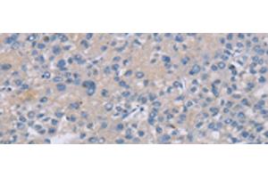 Immunohistochemistry of paraffin-embedded Human liver cancer tissue using CREBZF Polyclonal Antibody at dilution of 1:50(x200)