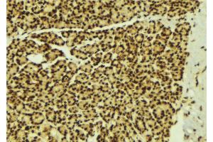 ABIN6269279 at 1/100 staining Human breast cancer tissue by IHC-P. (STAT5B antibody  (C-Term))