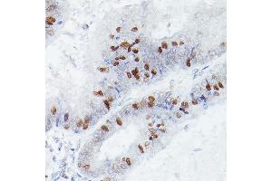 Immunohistochemistry of paraffin-embedded human colon carcinoma using RBPJK Rabbit mAb (ABIN1682563, ABIN3018511, ABIN3018512 and ABIN7101620) at dilution of 1:50 (40x lens). (RBPJ antibody)