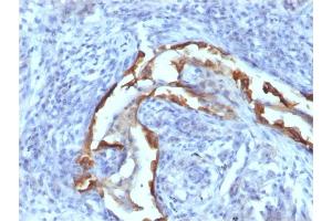 Formalin-fixed, paraffin-embedded human Lung Carcinoma stained with Cytokeratin 8 Mouse Monoclonal Antibody (SPM538)